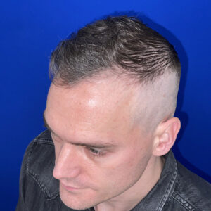 Best hair transplant chicago